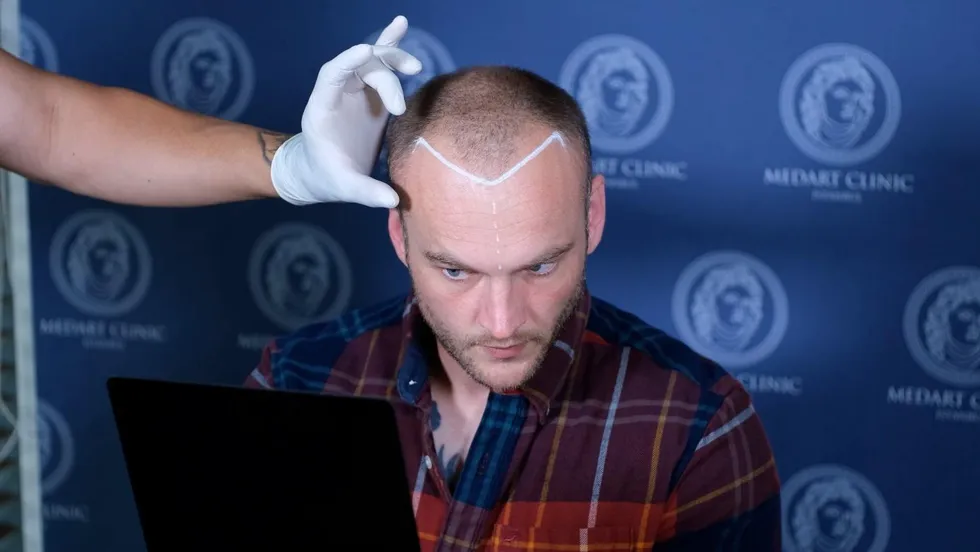hair-transplant-turkey