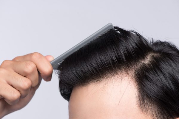 hair-hairline_641014171