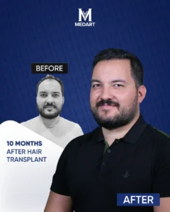 Hair Transplant Turkey Before After 10 Month