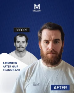 Hair Transplant Turkey Before After 6 Months