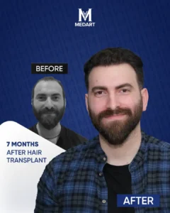 Hair Transplant Turkey Before After 7 Month