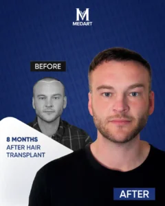 Hair Transplant Turkey Before After 8 Month