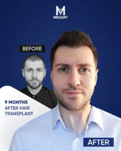 Hair Transplant Turkey Before After 9 Month
