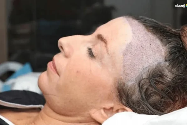 kadinlarda-sac-ekimi