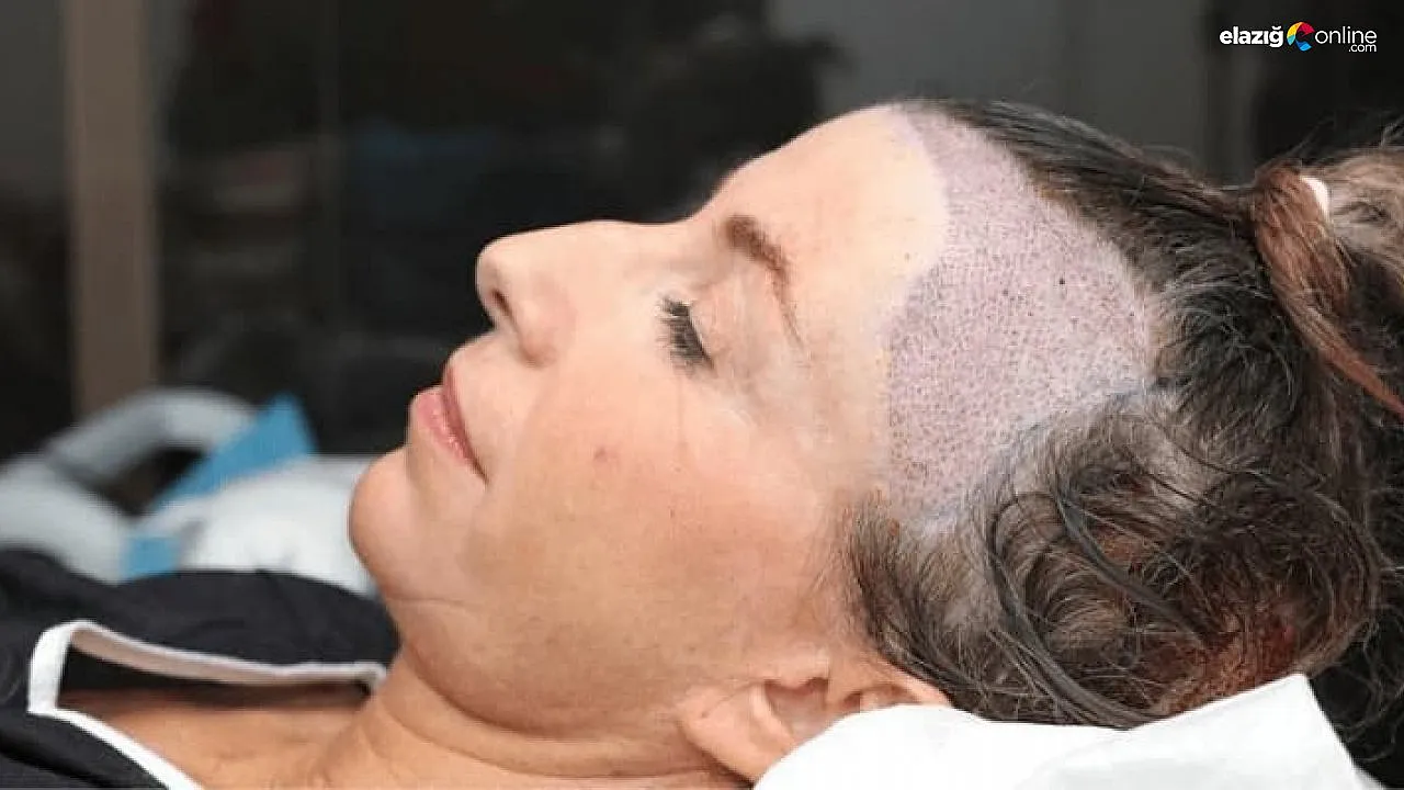 kadinlarda-sac-ekimi